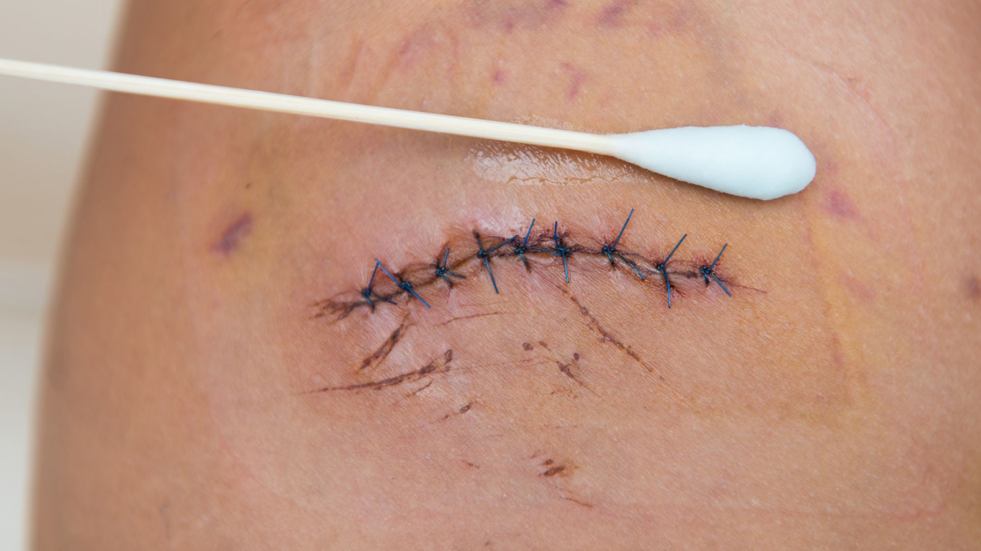 Quan hệ tình dục sớm sau phẫu thuật có thể gây tổn thương cho vết mổ