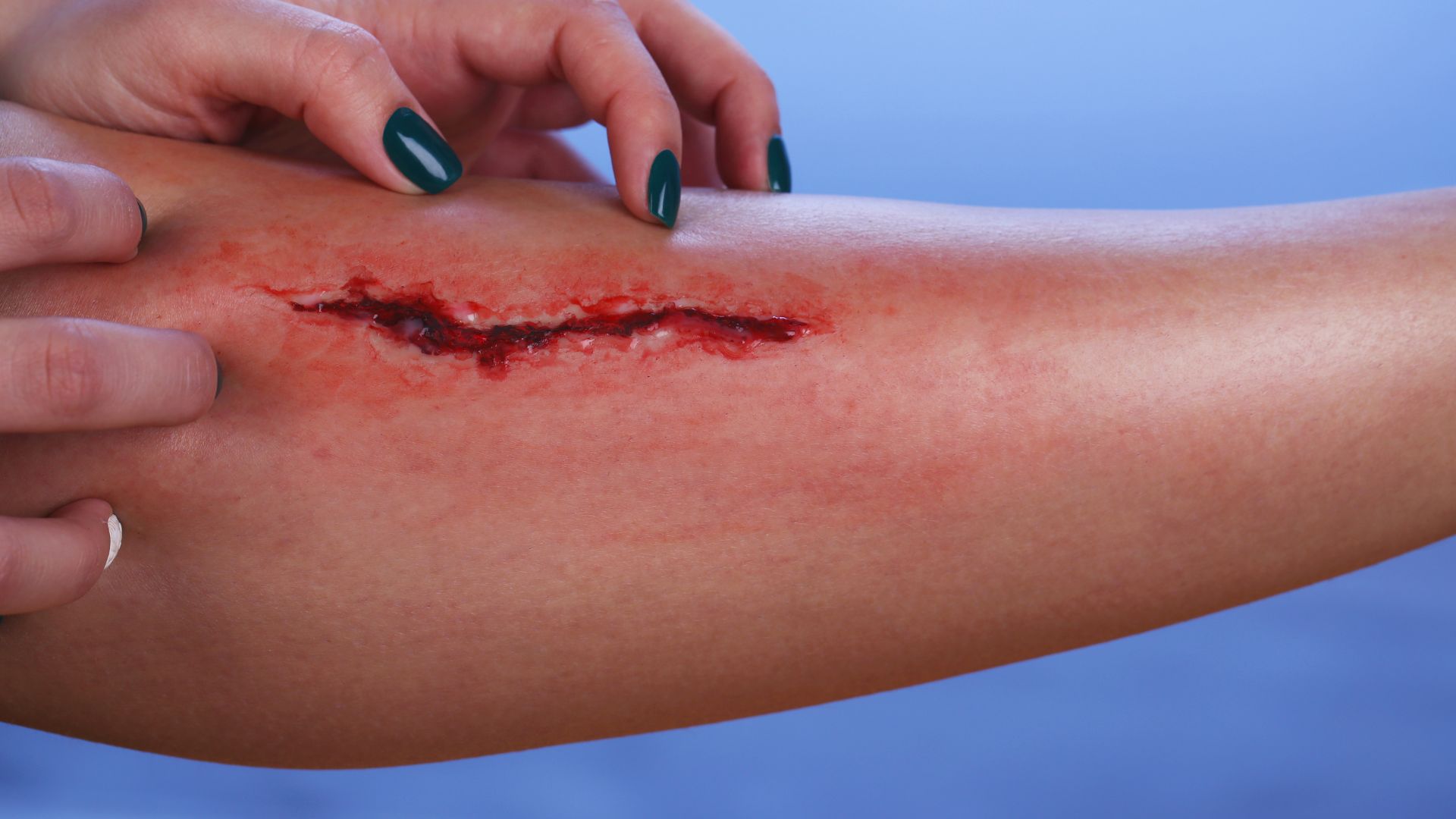 Người bệnh nên kiêng ăn đồ nếp nếu vết thương sau mổ bị viêm nhiễm