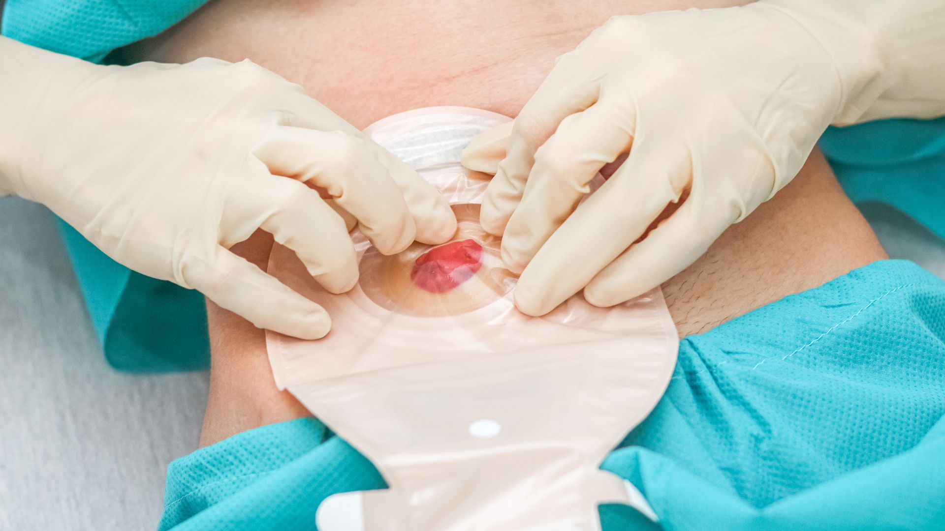 Sau phẫu thuật có được ăn khoai lang không?