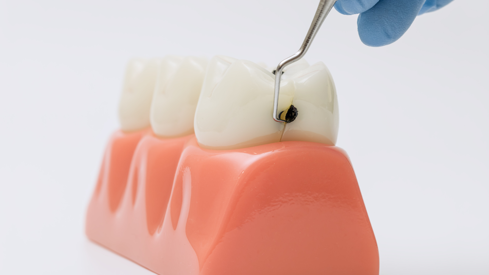 Sâu răng là quá trình phá hủy mô cứng của răng do axit do vi khuẩn trong mảng bám tạo ra