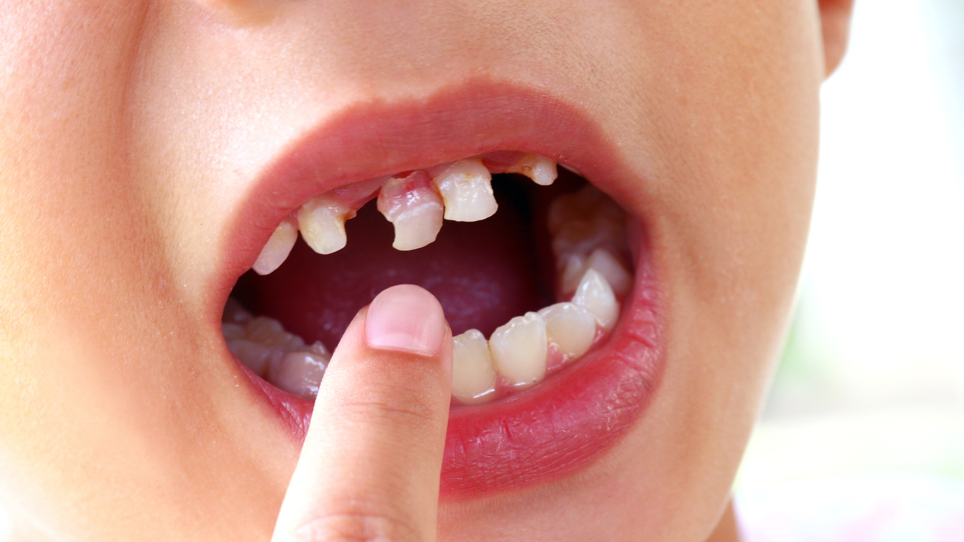 Sâu răng ở trẻ em thường diễn ra nhanh do cấu trúc răng sữa mỏng