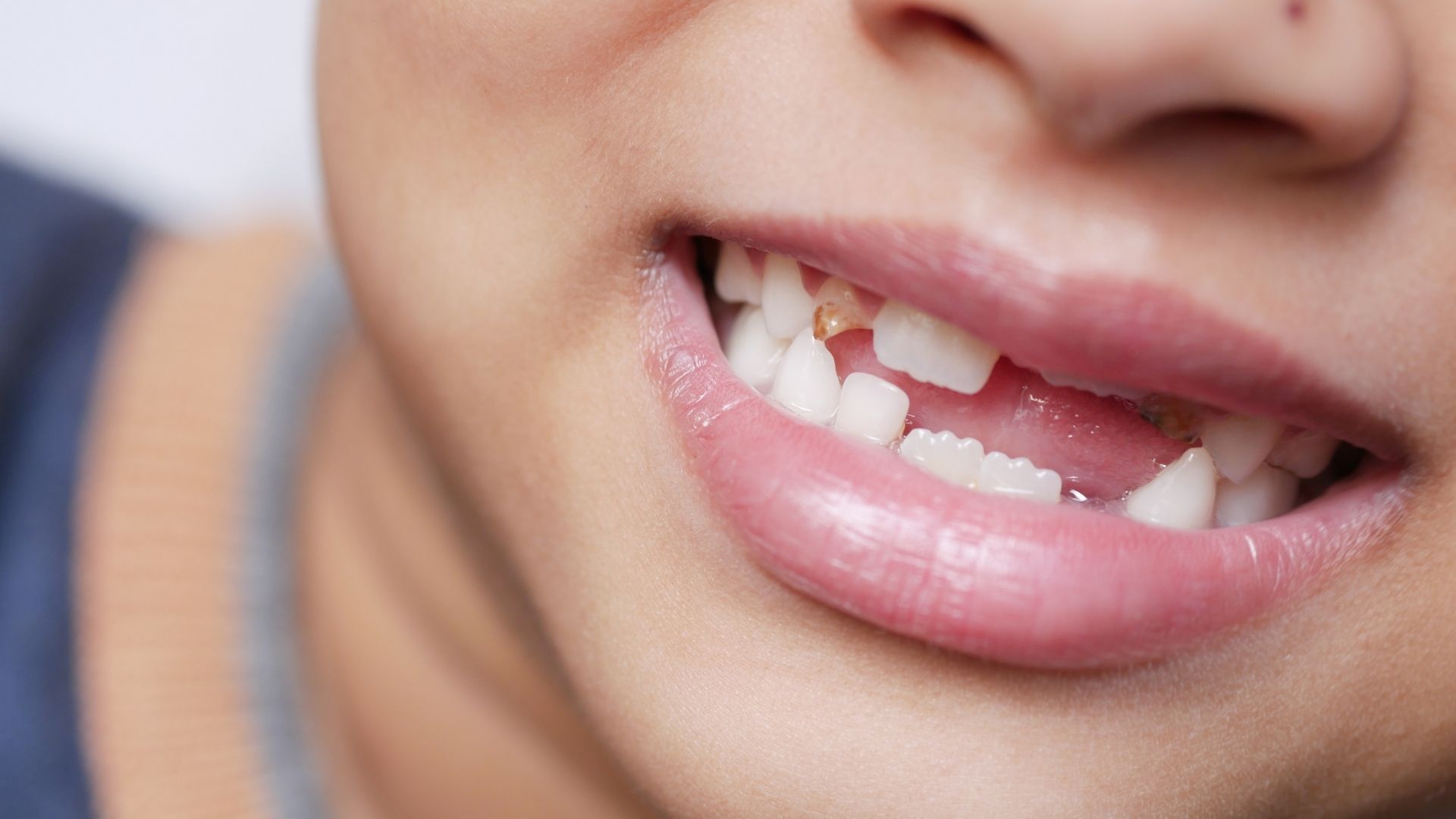 Sâu răng sữa có thể khiến trẻ bị hỏng cấu trúc răng