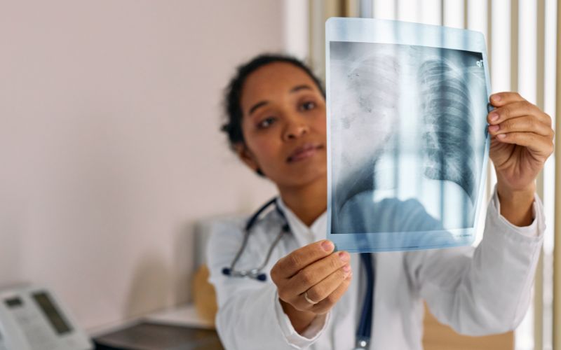 Xét nghiệm SCC đóng vai trò quan trọng phát hiện ung thư phổi tế bào vảy