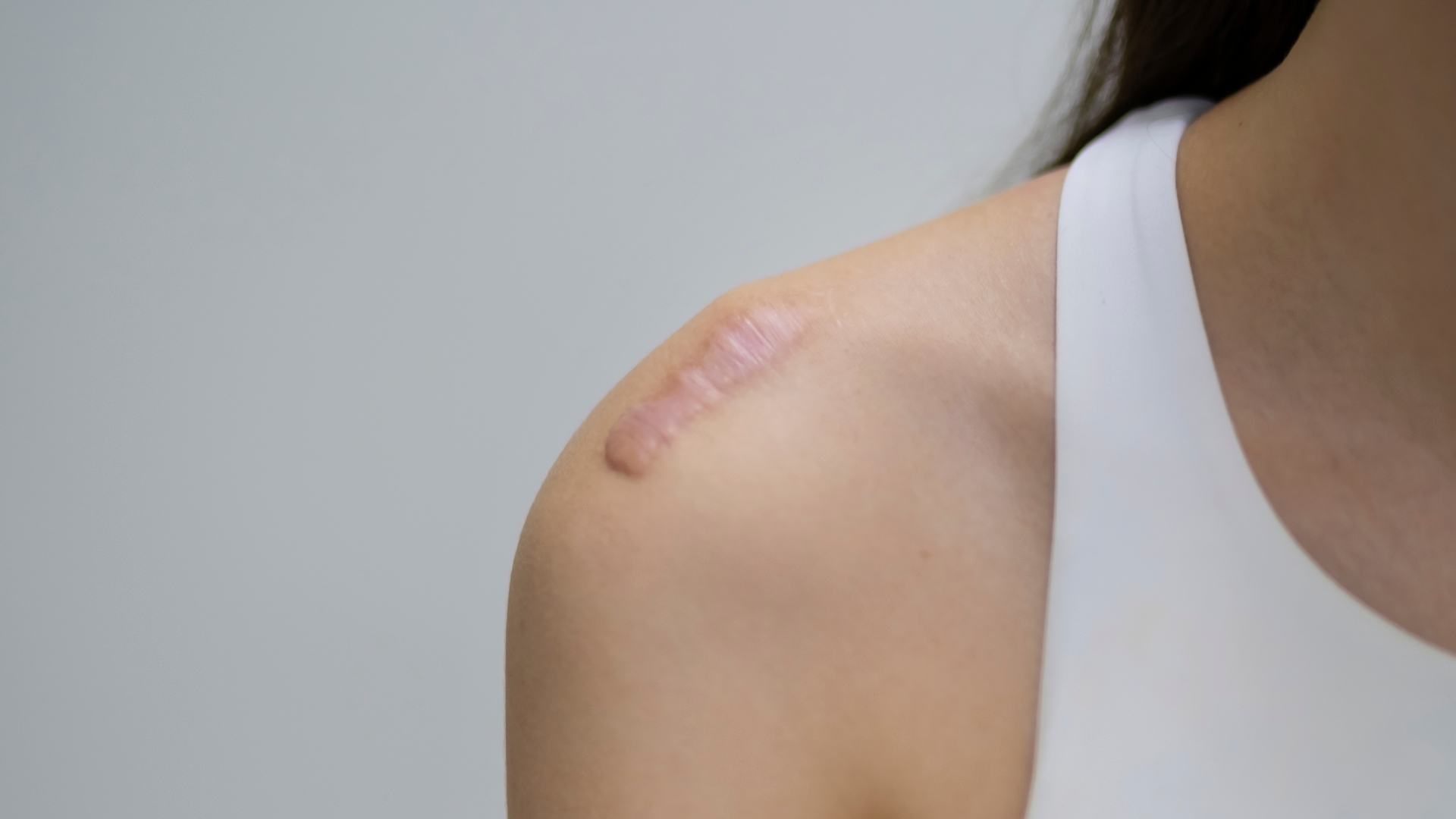 Sẹo lồi là gì? Nguyên nhân và yếu tố nguy cơ gây sẹo lồi 2