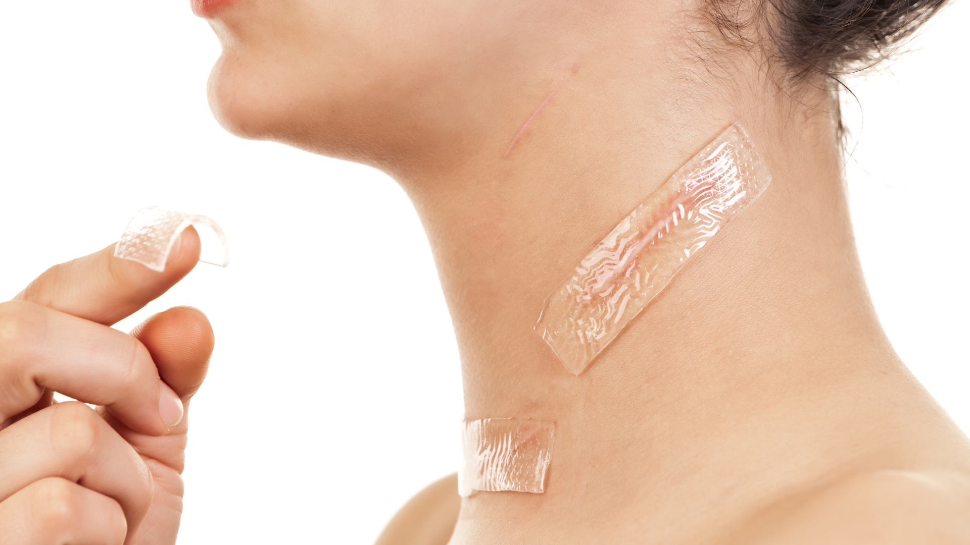 Sẹo lồi là gì? Nguyên nhân và yếu tố nguy cơ gây sẹo lồi 5