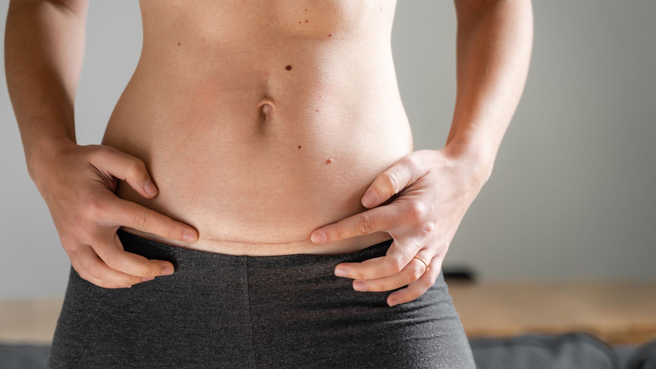 Sẹo lồi là một trong những dạng sẹo mổ đẻ thường gặp