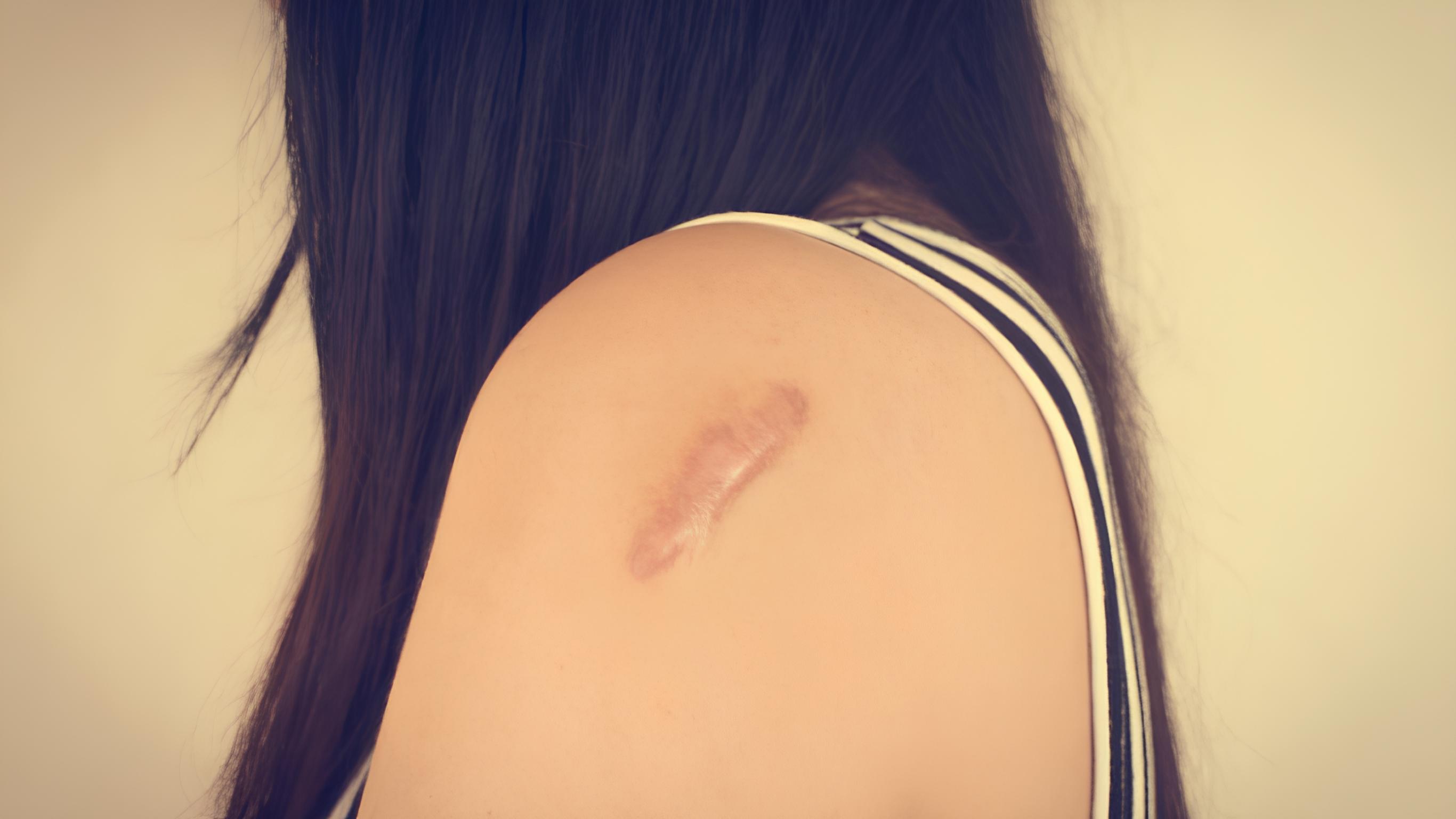 Sẹo phì đại là gì? Sẹo lồi và sẹo phì đại có giống nhau không? 1