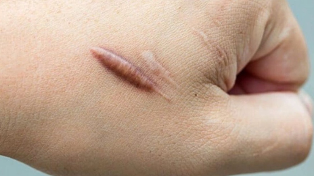 Sẹo phì đại là gì? Sẹo lồi và sẹo phì đại có giống nhau không? 3