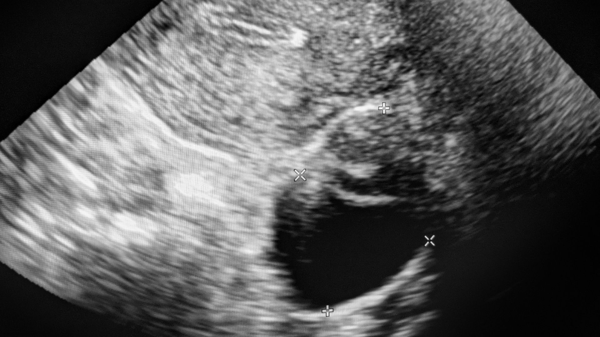 Các phương pháp siêu âm buồng trứng giúp bác sĩ đánh giá chi tiết cấu trúc và chức năng buồng trứng