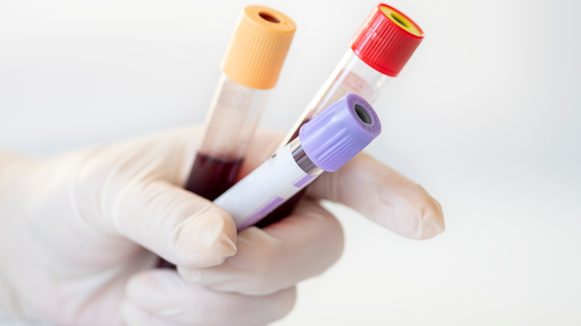 Để chẩn đoán suy thận hiệu quả, cần siêu âm song song xét nghiệm máu chuyên sâu