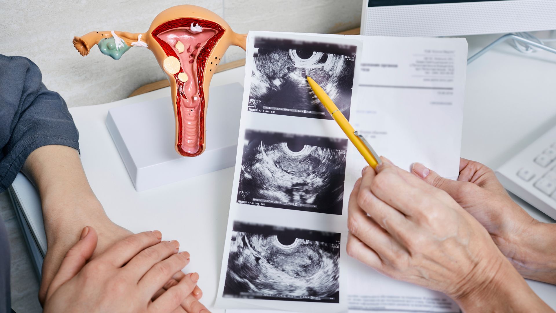 Siêu âm có phát hiện tắc vòi trứng không? Những điều phụ nữ cần biết 1