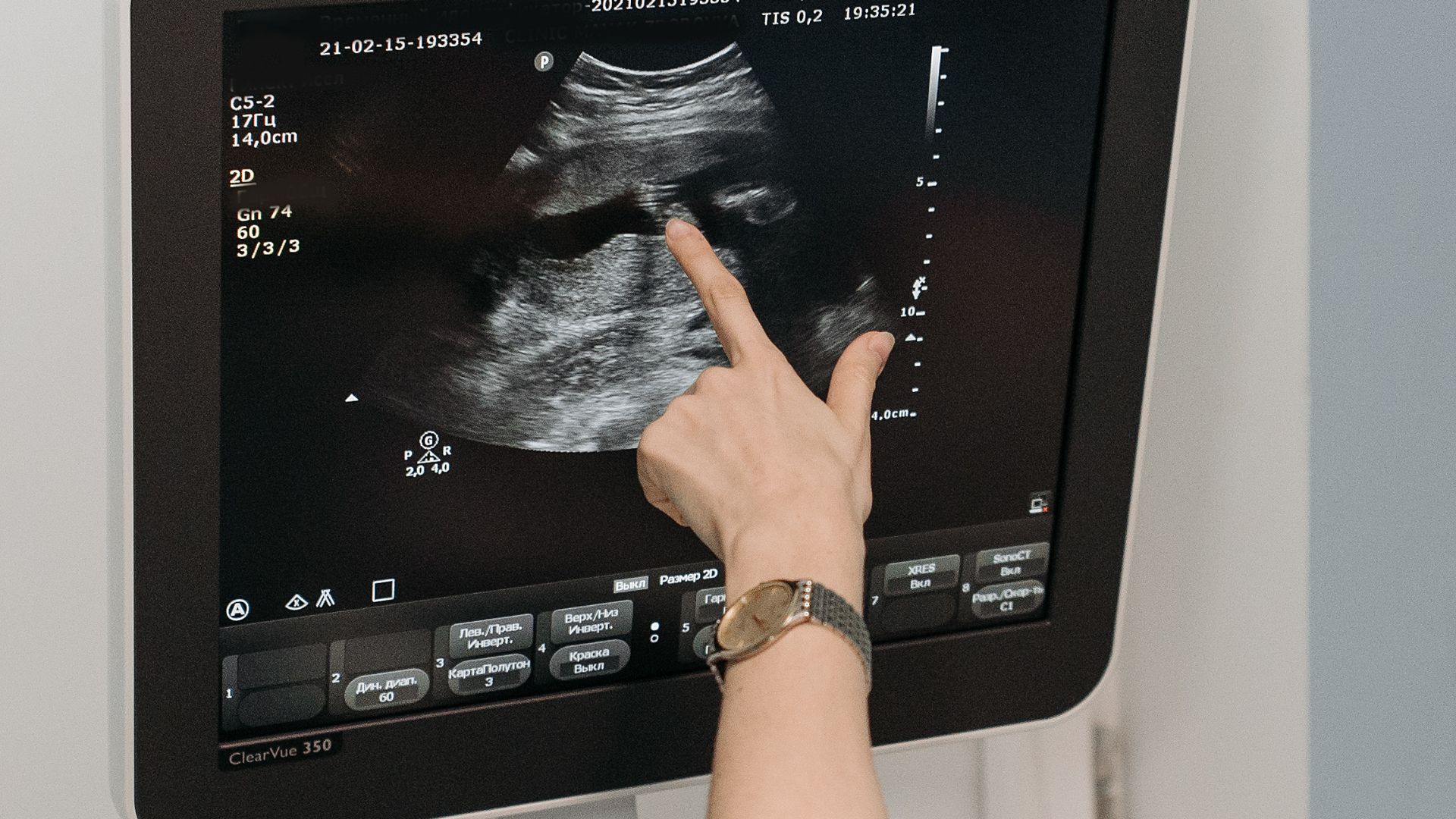 Siêu âm Doppler tim mang lại nhiều lợi ích trong việc theo dõi sức khỏe tim mạch