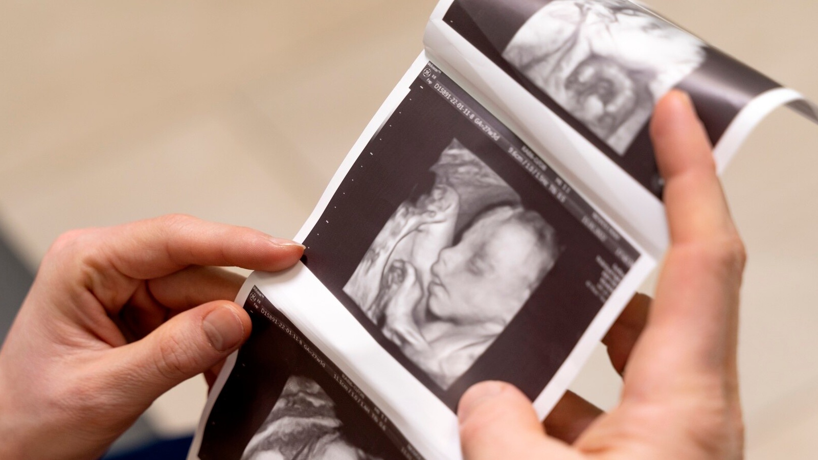 Siêu âm hình thái học giúp phát hiện sớm nhiều bất thường cấu trúc của thai nhi