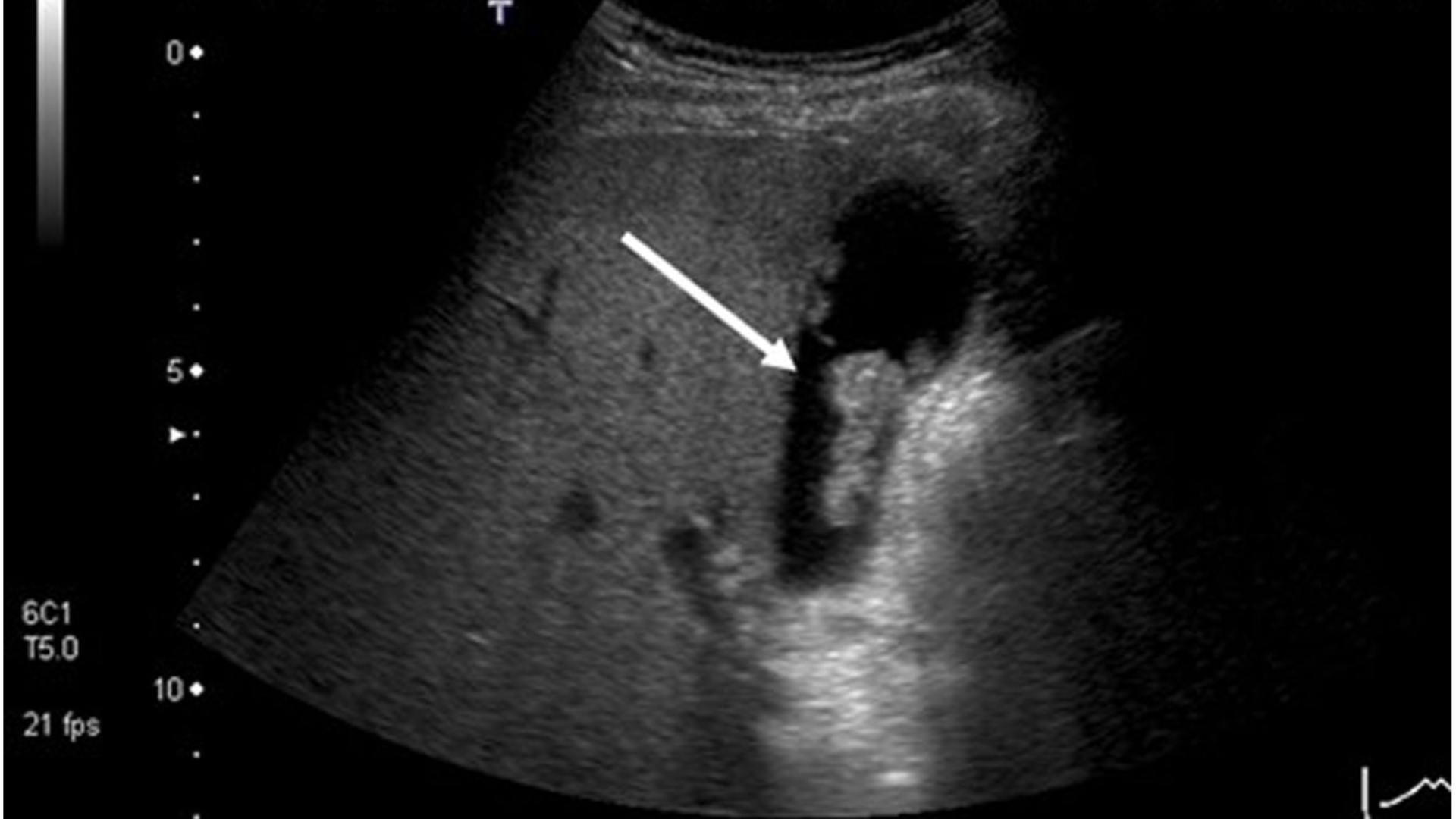 Trên siêu âm, polyp túi mật được mô tả là cấu trúc tăng âm nằm trong lòng túi mật