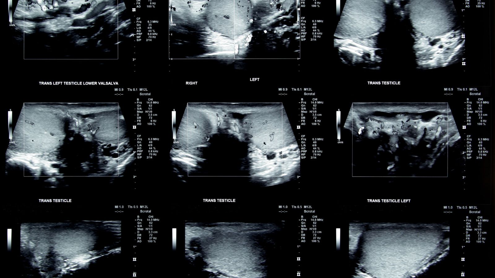 sieu-am-tinh-hoan-phat-hien-nhung-benh-gi-1