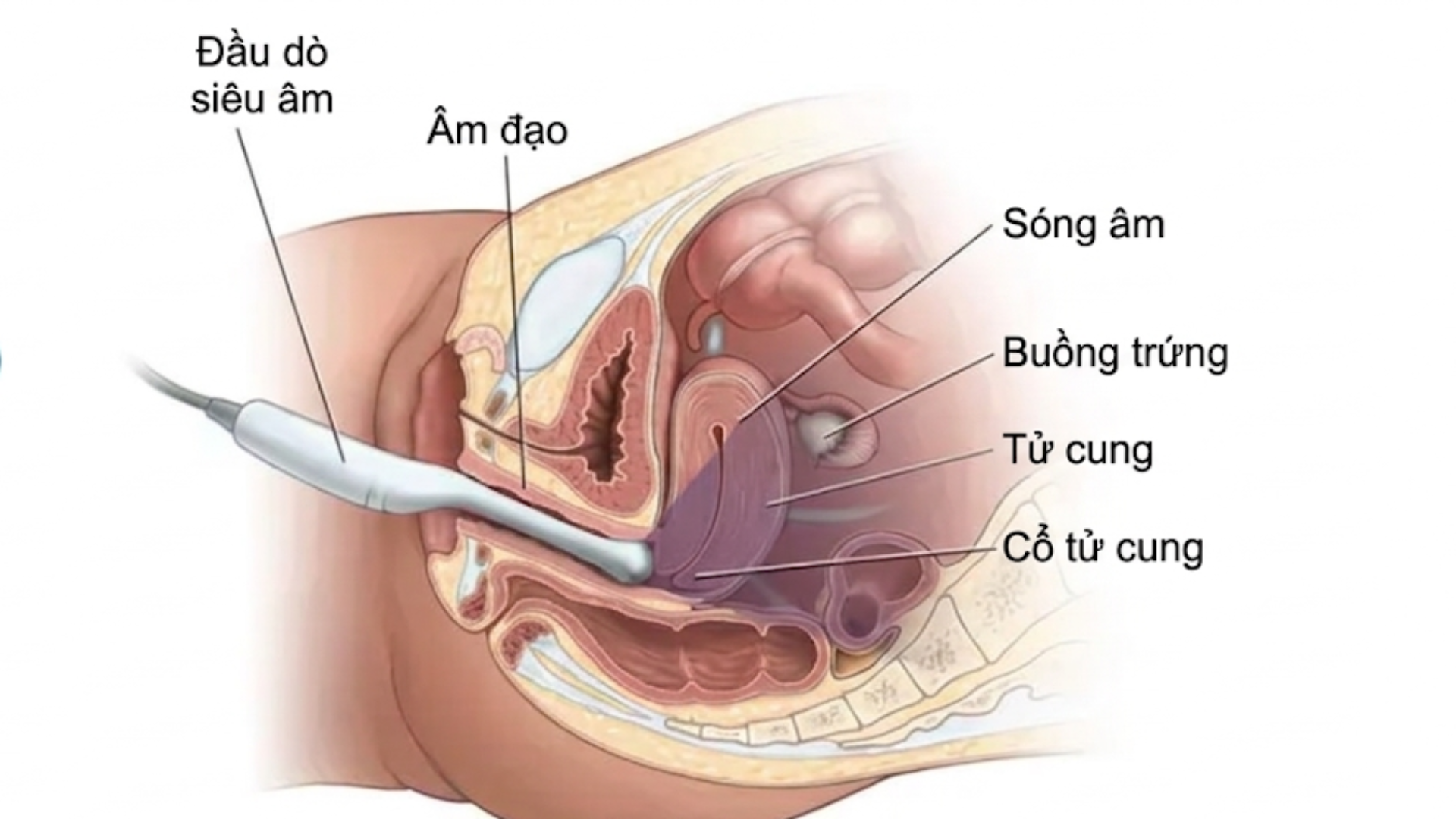Siêu âm tử cung là kỹ thuật dùng sóng siêu âm tần số cao để tạo hình ảnh tử cung và các cơ quan xung quanh