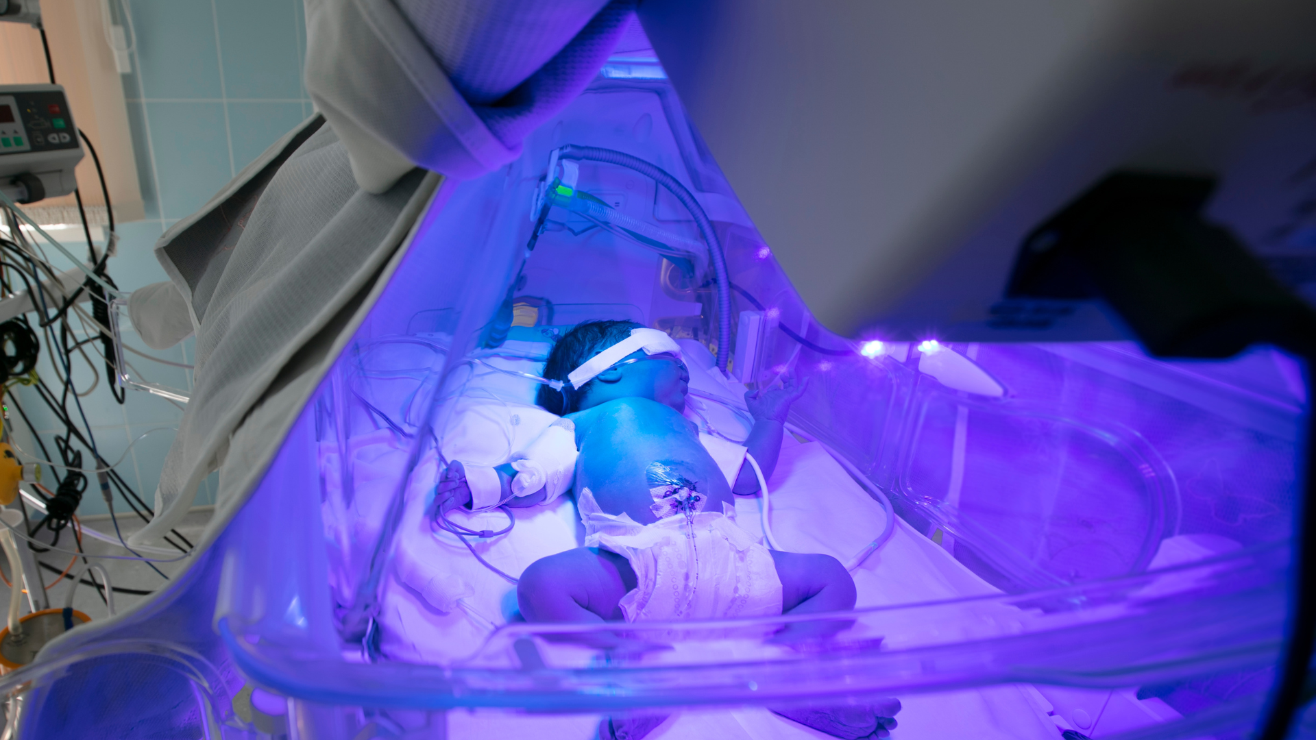 Sinh non 25 tuần có nuôi được không là câu hỏi khiến nhiều cha mẹ lo lắng