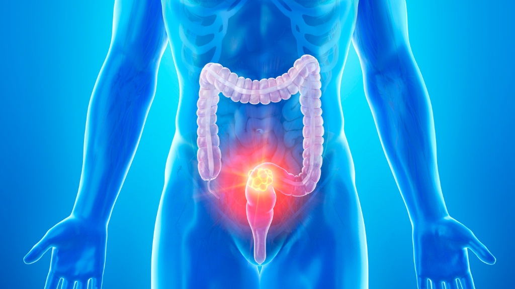 Sinh thiết đại tràng bao lâu có kết quả? Cần lưu ý những gì khi thực hiện 4