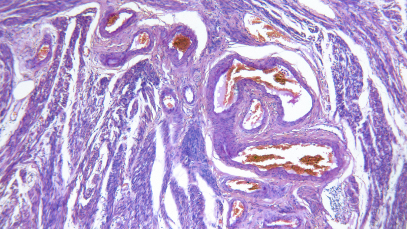 Sinh thiết nội mạc tử cung: Quy trình và những lưu ý quan trọng 2