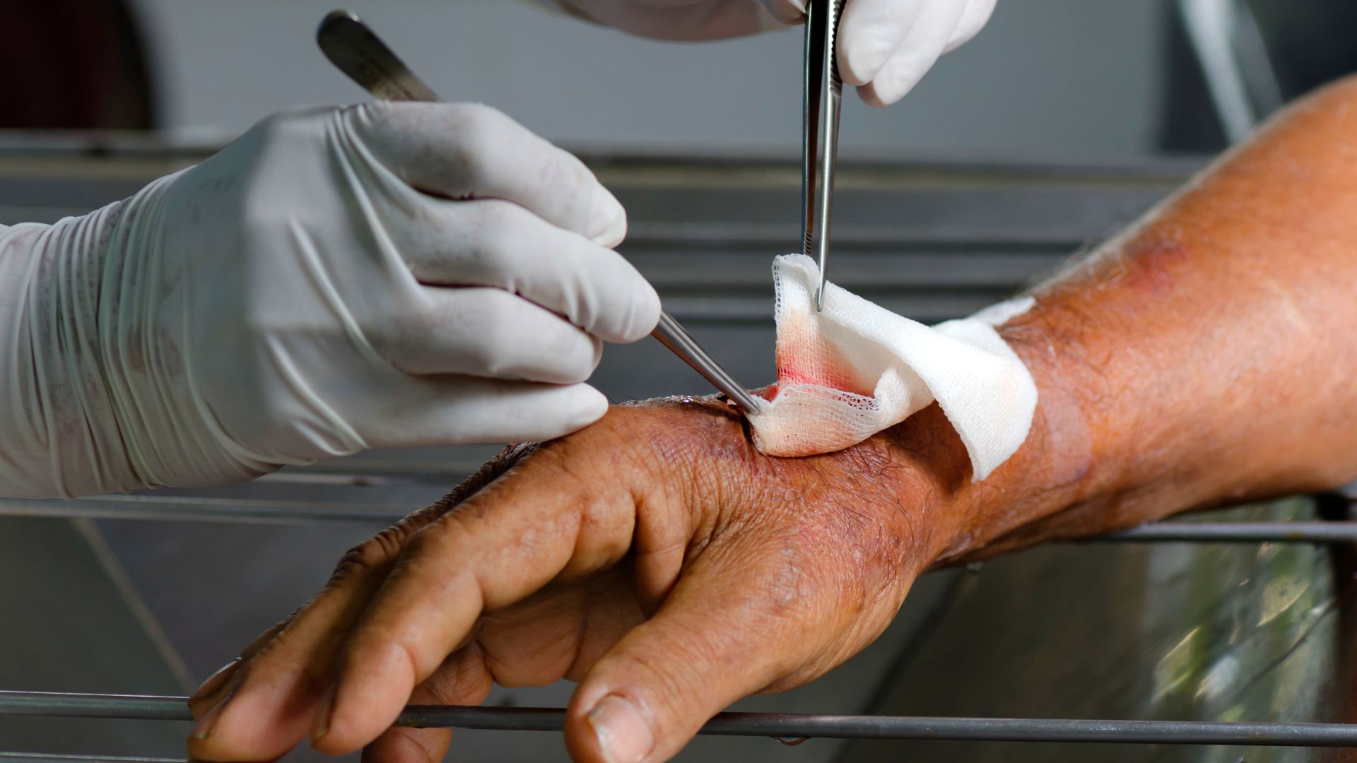 Sơ cứu vết thương ngoài da: Cách xử lý đúng và an toàn cho người bệnh 2