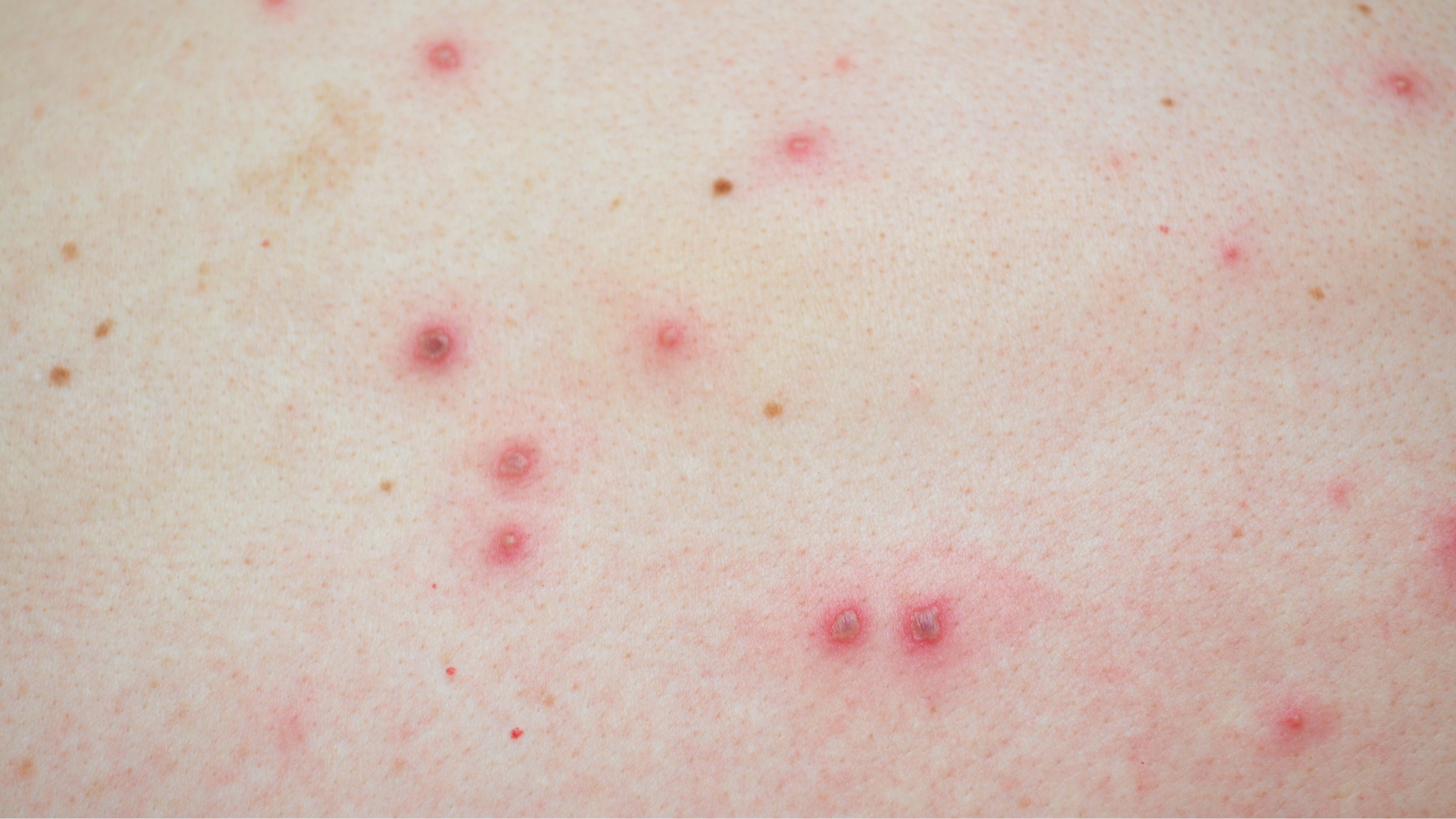 so-sanh-benh-dau-mua-va-thuy-dau-cach-phong-ngua-va-cham-soc-khi-mac-phai (2).png