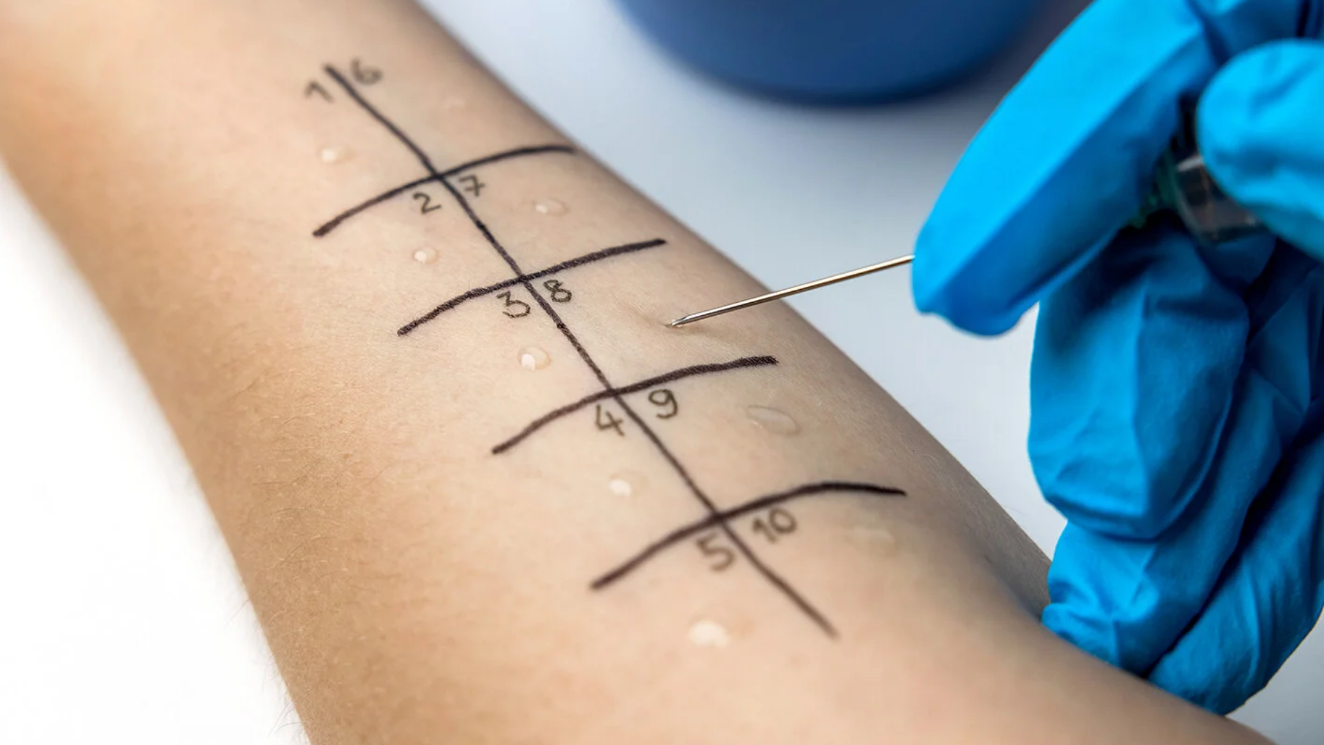 Test dị ứng da giúp xác định dị nguyên nghi ngờ
