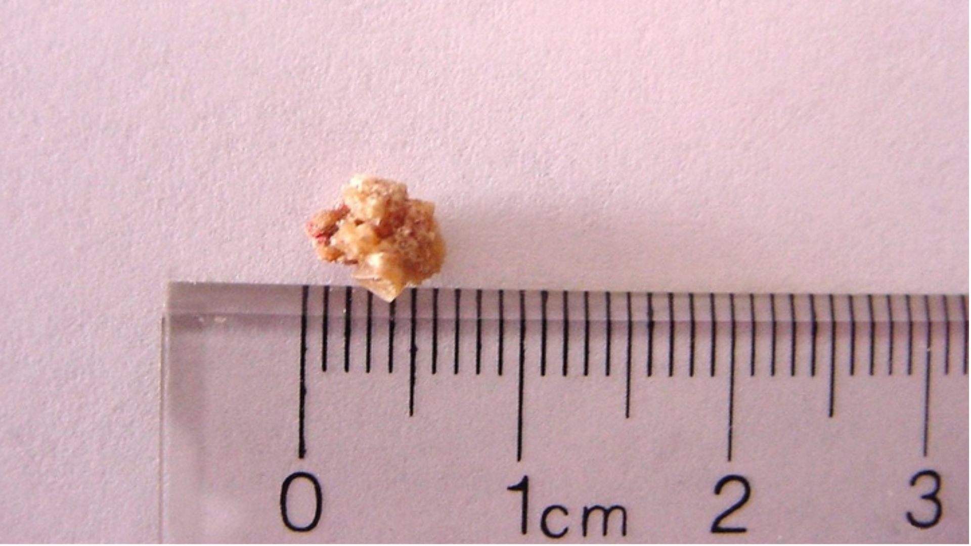 Với sỏi nhỏ dưới 5mm, cơ thể thường có khả năng tự đẩy ra ngoài