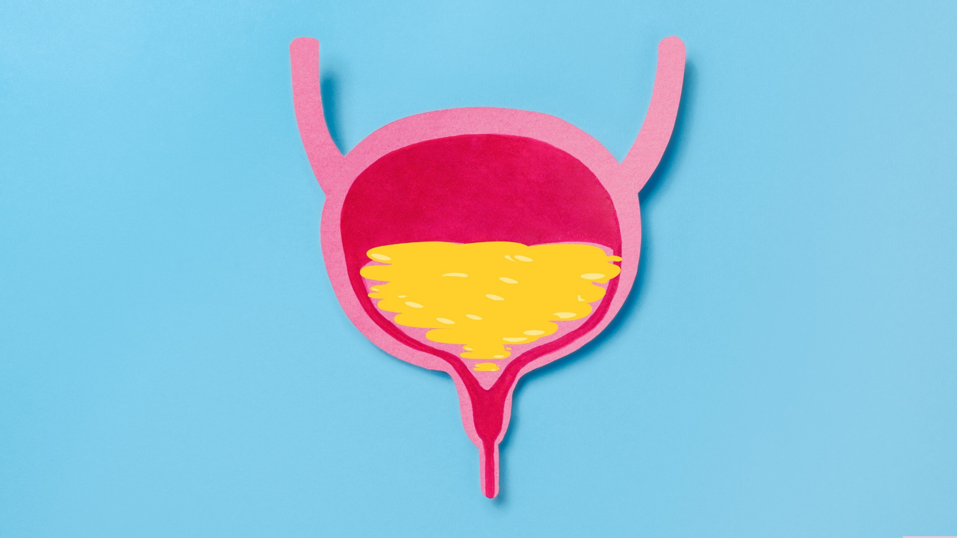 Nước tiểu ứ đọng là môi trường lý tưởng cho vi khuẩn phát triển, dẫn đến viêm bể thận cấp hoặc áp-xe thận