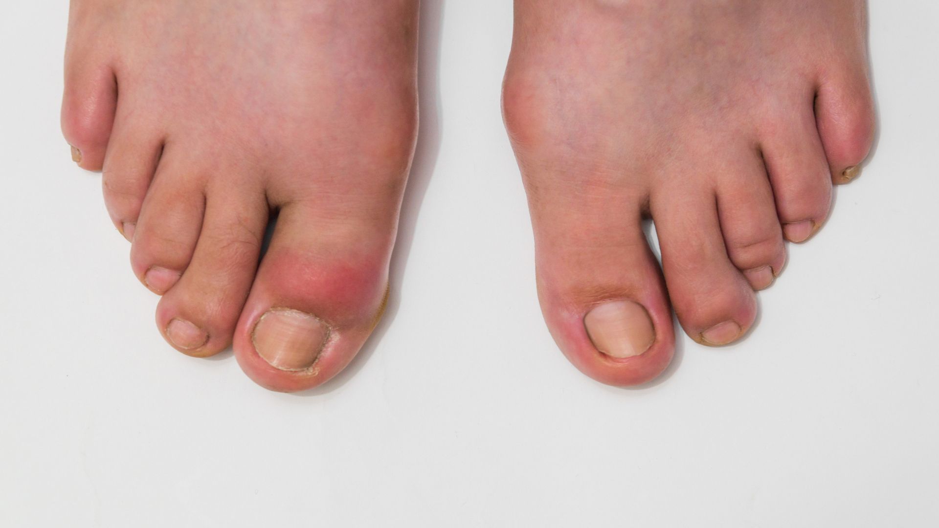 Bệnh gout có thể làm tăng nguy cơ mắc bệnh sỏi thận
