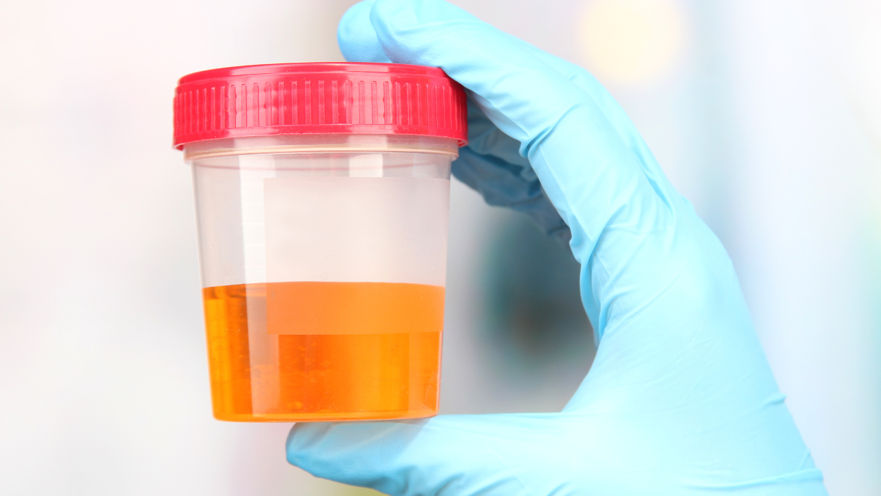 Sỏi thận khiến nước tiểu có máu, đục hoặc có mùi hôi