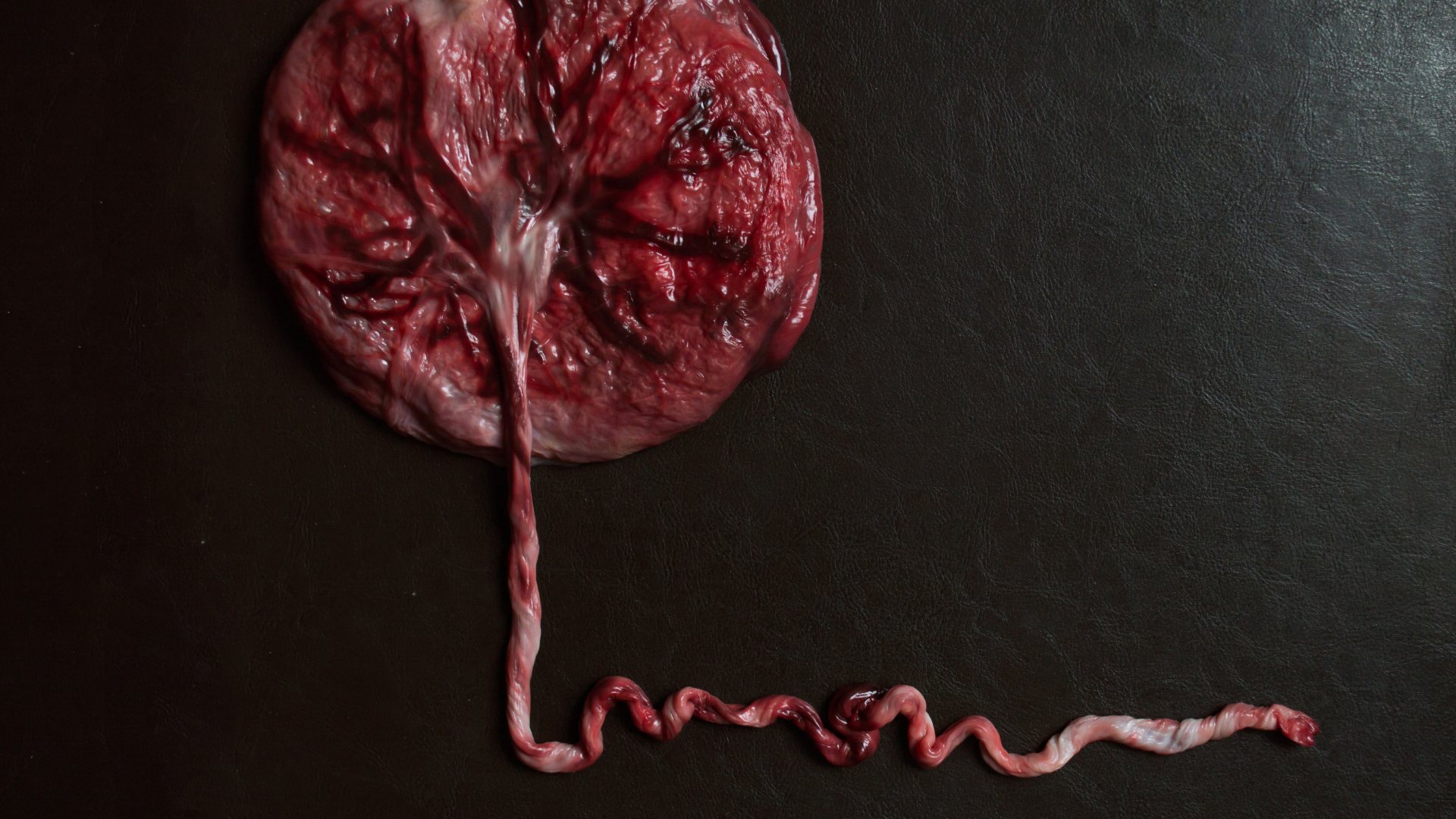 Rối loạn phát triển bánh nhau cũng góp phần khiến song thai 3 tháng đầu có 1 thai ngừng phát triển