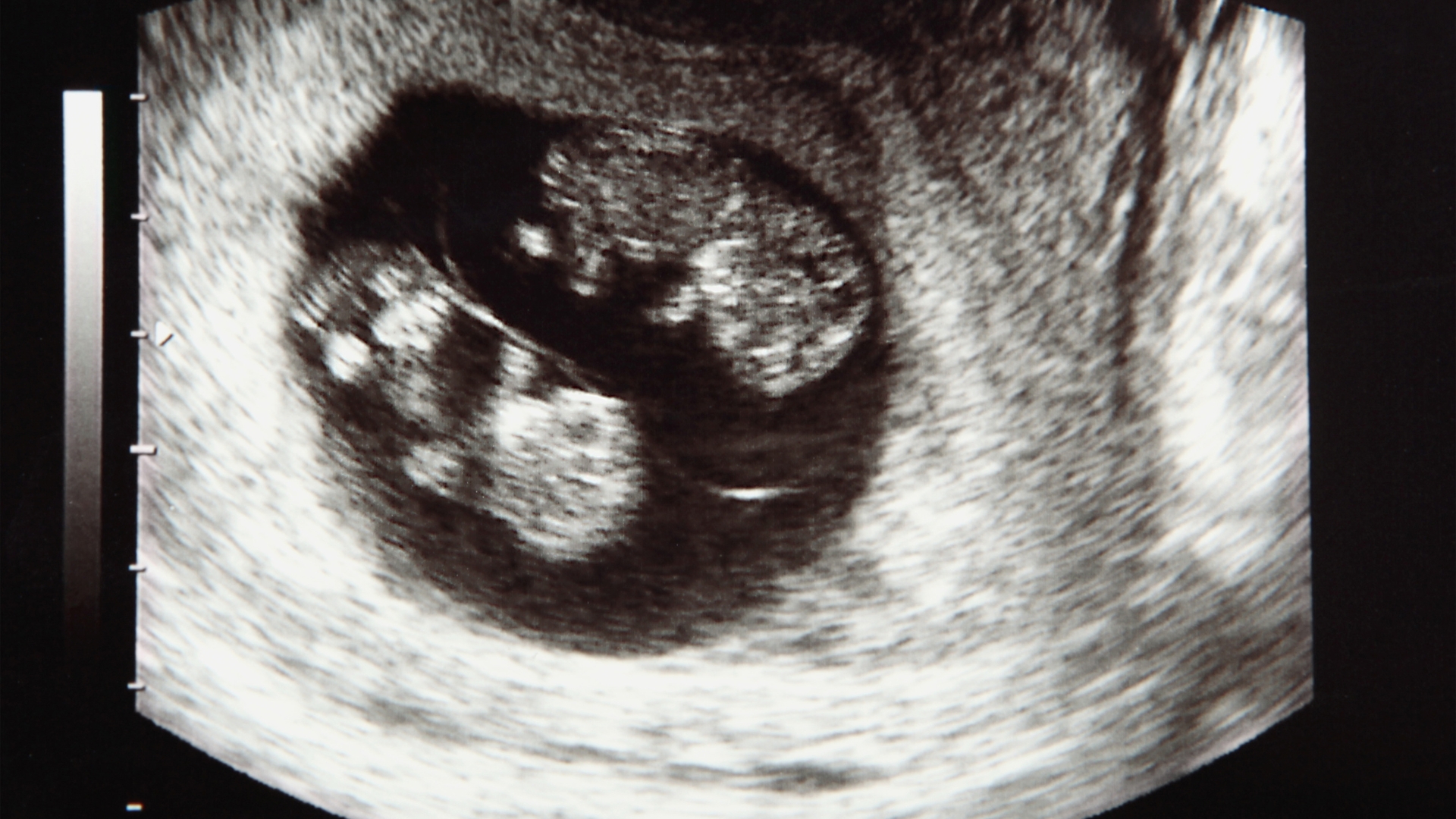 Qua các kỹ thuật hỗ trợ sinh sản hiện nay như IVF, kích trứng, tỷ lệ mang song thai có xu hướng gia tăng