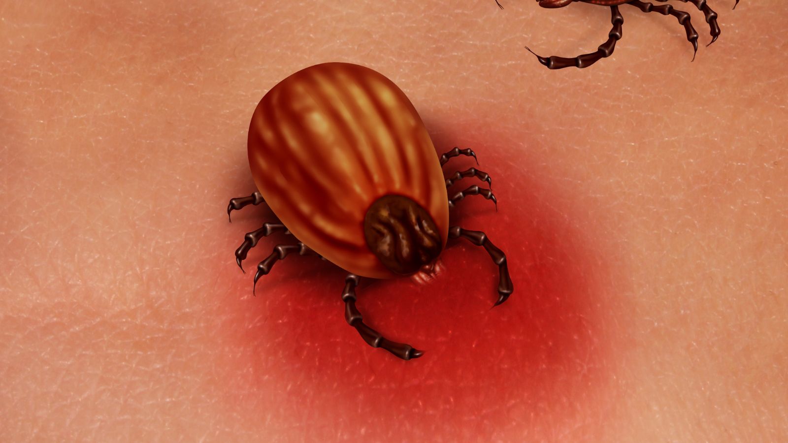 Sốt mò là bệnh truyền nhiễm cấp tính do vi khuẩn Orientia tsutsugamushi gây ra.