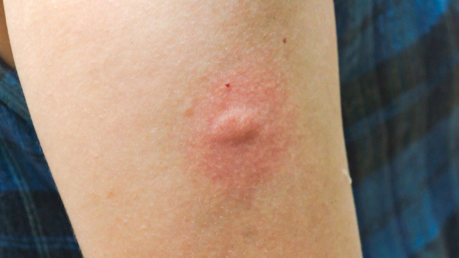 Vết loét là dấu hiệu đặc trưng quan trọng nhất giúp nhận biết sốt mò.