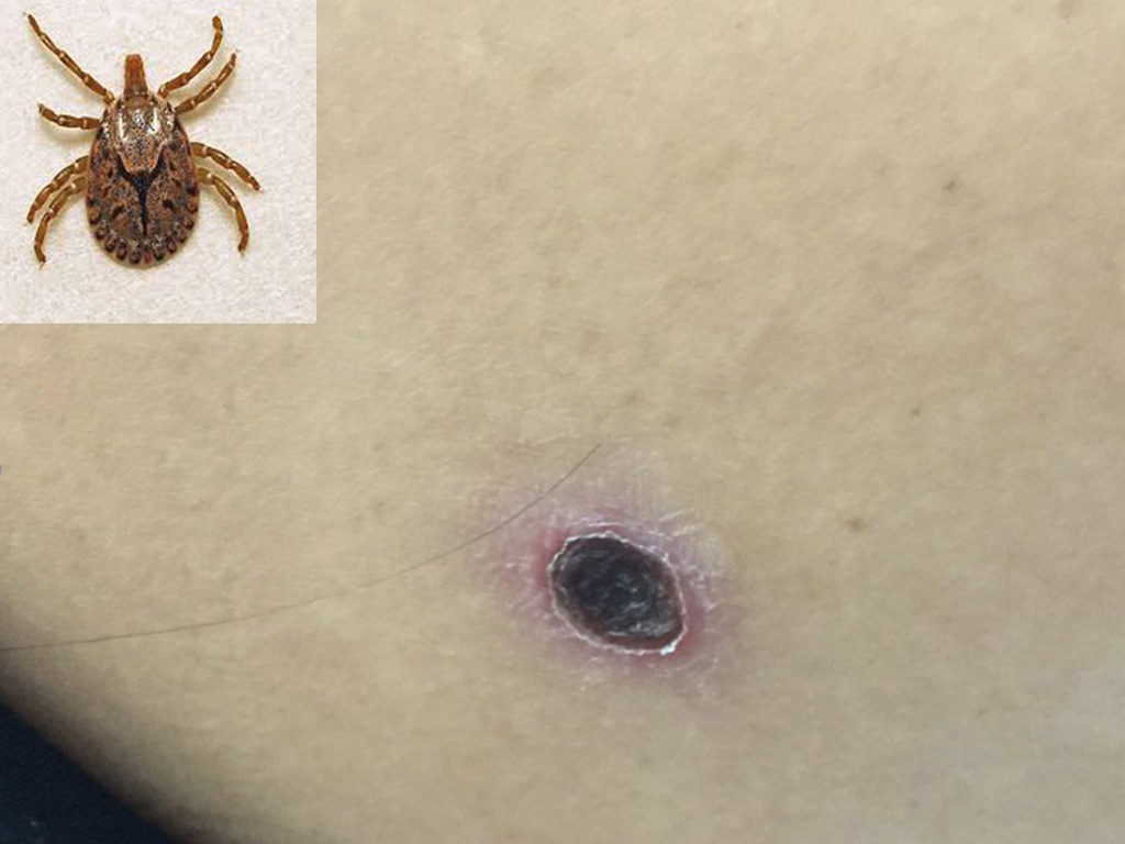 Sốt mò được nhận biết bằng vết loét đặc trưng ở những vùng da mềm, ẩm