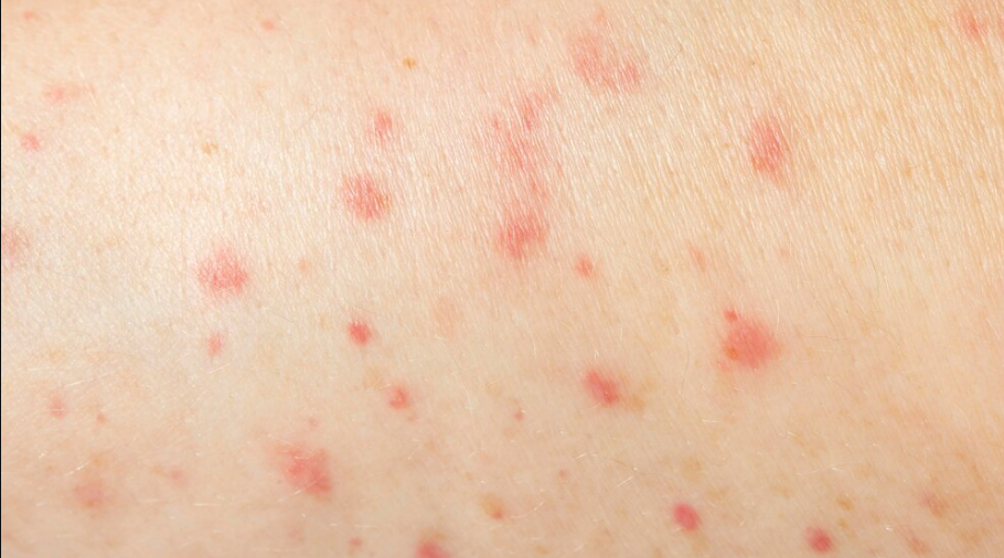 sot-phat-ban-dang-soi-la-gi 1