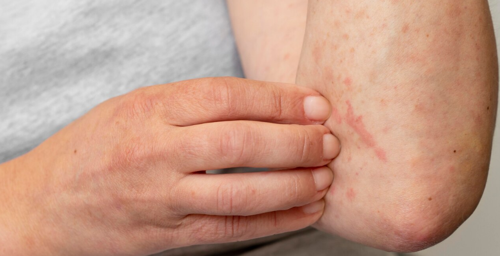 sot-phat-ban-dang-soi-la-gi 2