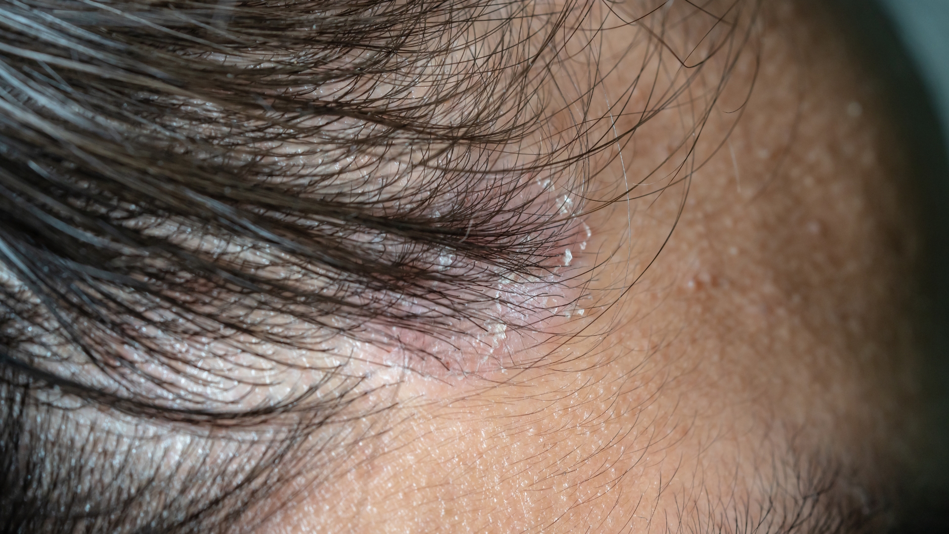 sot-xuat-huyet-co-duoc-goi-dau-khong 2.jpg