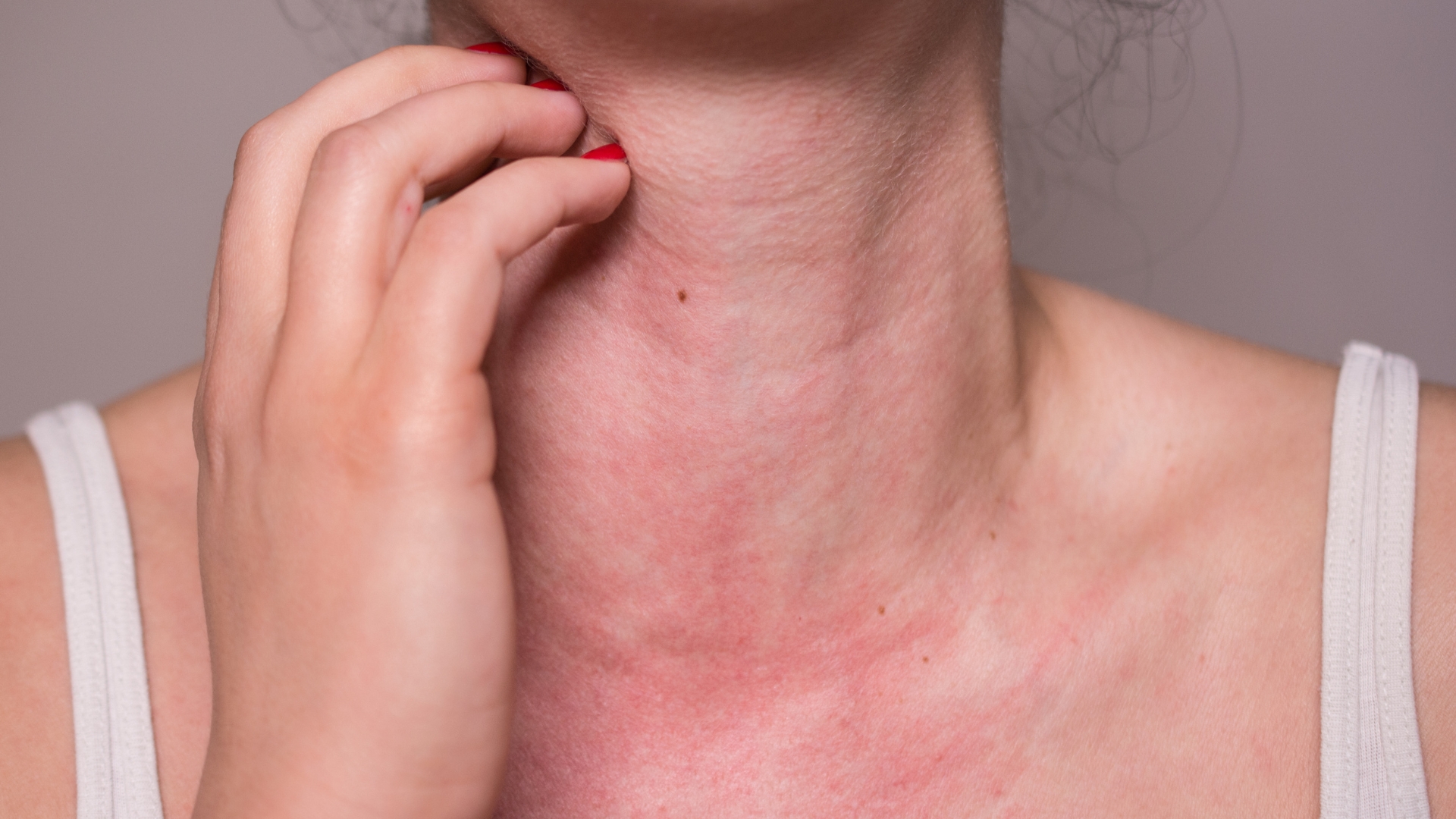 sot-xuat-huyet-co-ngua-khong 02.jpg