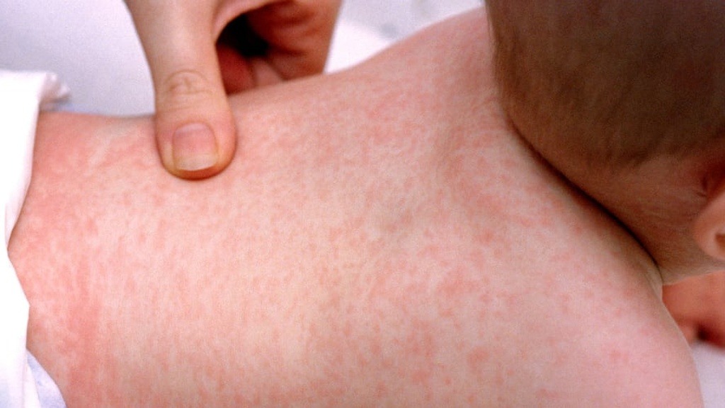 Các nốt sốt xuất huyết xuất hiện dưới dạng các chấm đỏ li ti