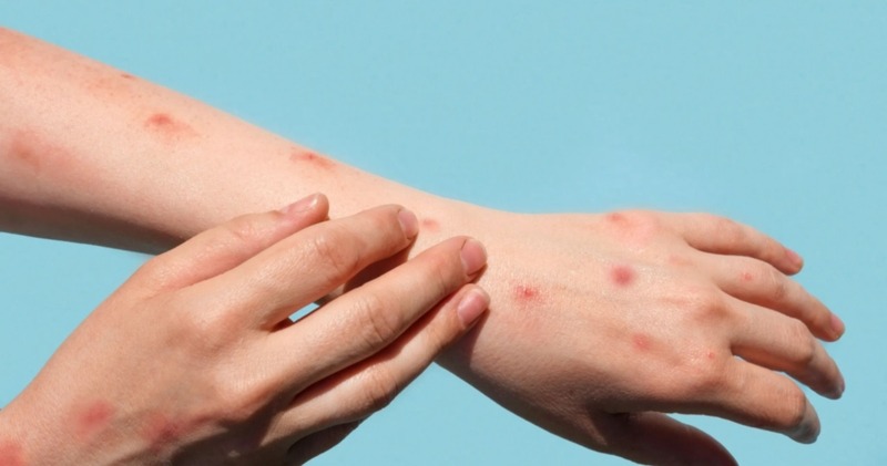 Việc phân biệt đúng sốt xuất huyết và dị ứng là rất quan trọng