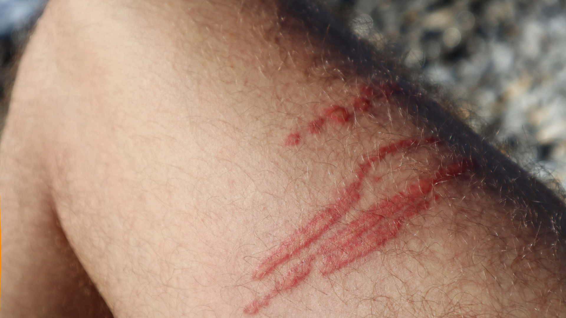 Sứa cắn có thể nhẹ hoặc nguy hiểm tùy loài và lượng nọc độc