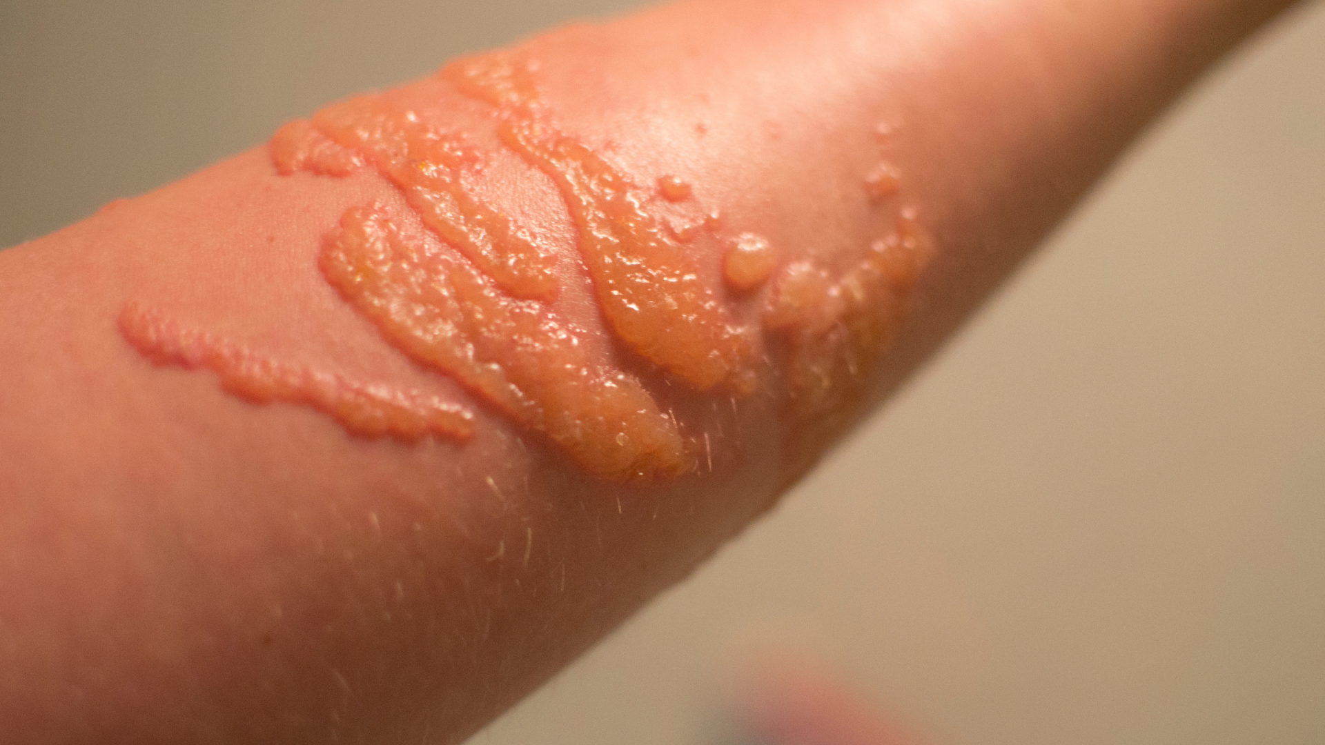 Sơ cứu đúng cách giúp giảm đau và hạn chế nọc độc