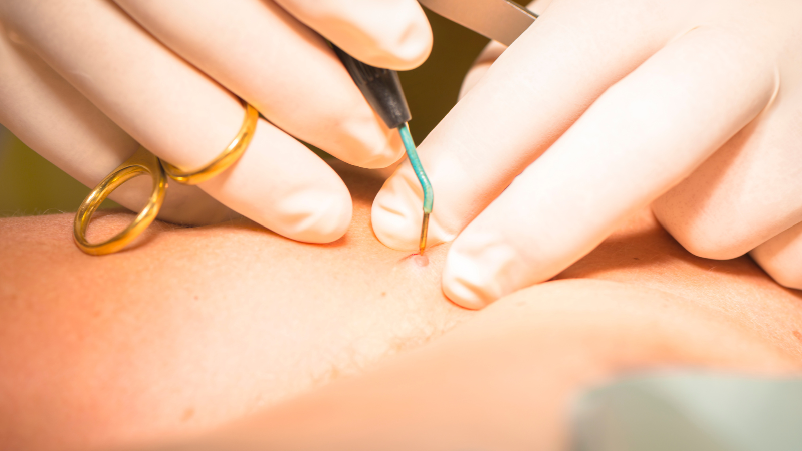 Phẫu thuật cắt bỏ là phương pháp đơn giản, trực tiếp