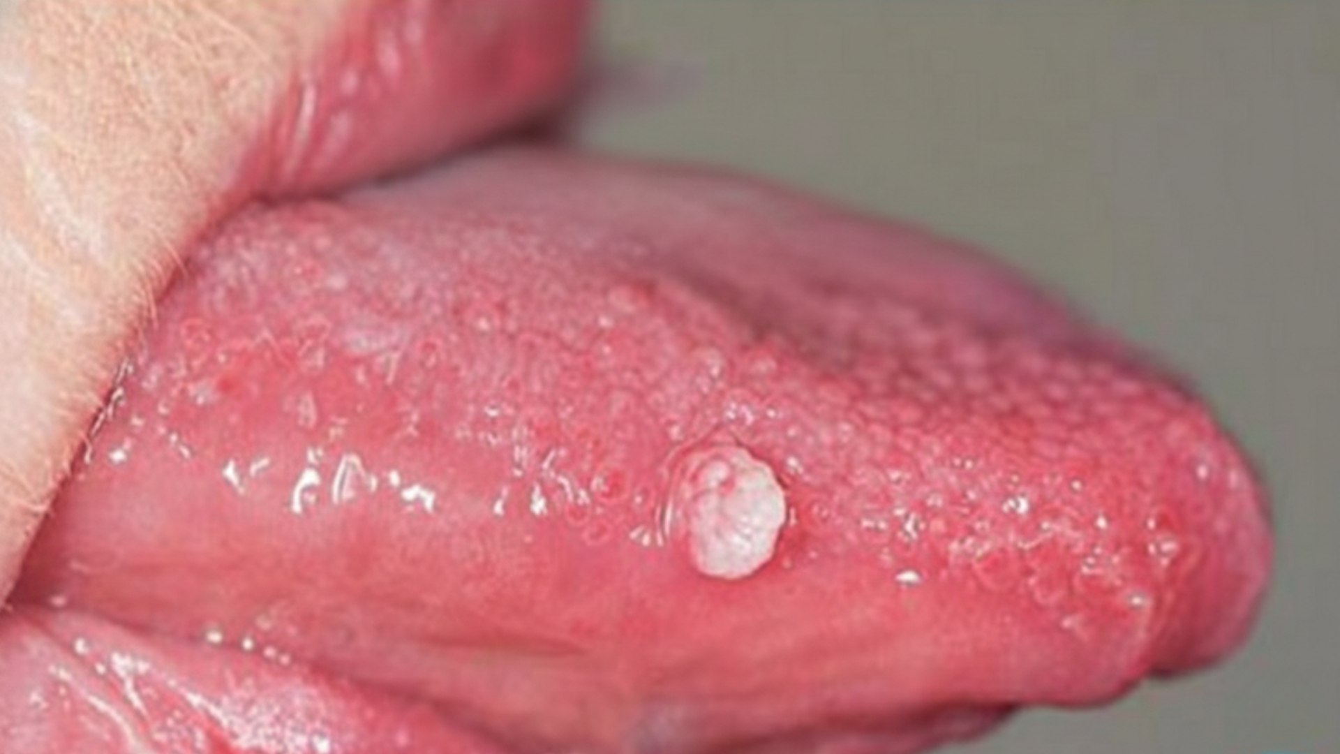 Hình ảnh sùi mào gà ở lưỡi giai đoạn đầu thường khá kín đáo