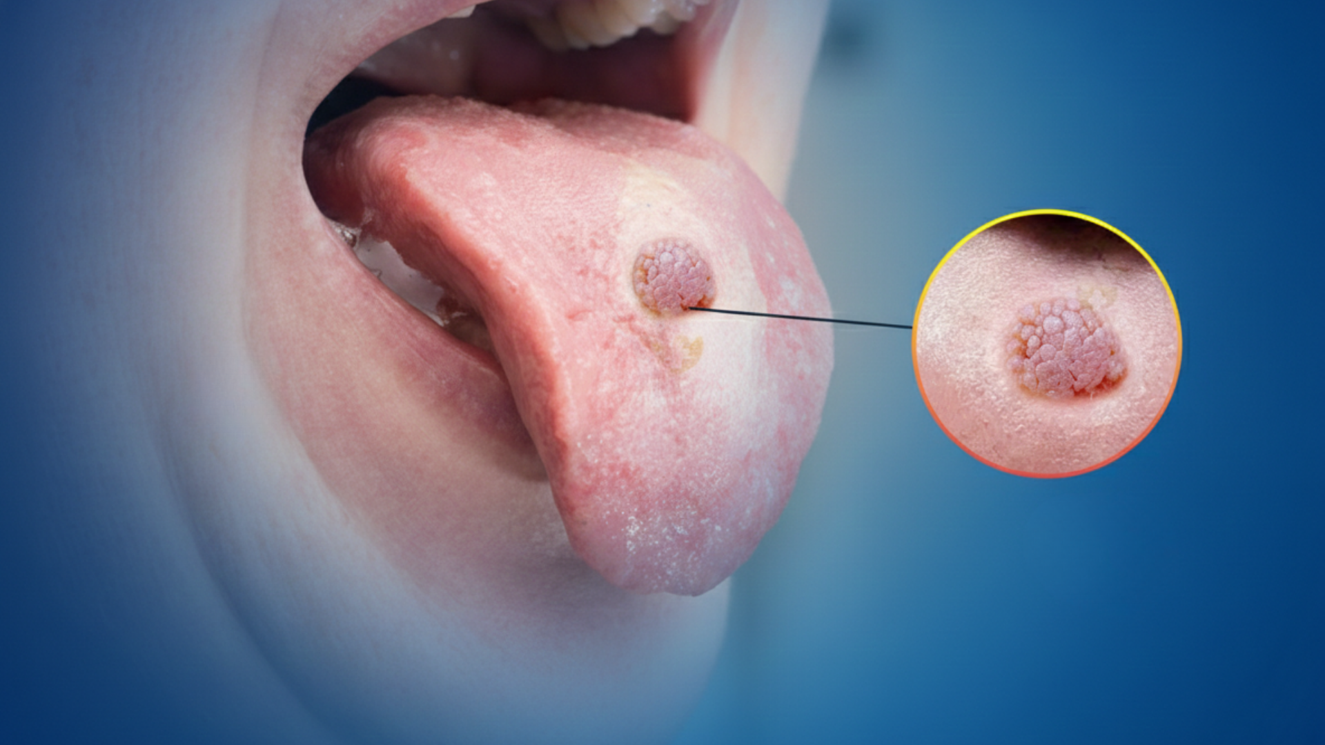 Nguyên nhân gây sùi mào gà ở lưỡi liên quan đến virus HPV