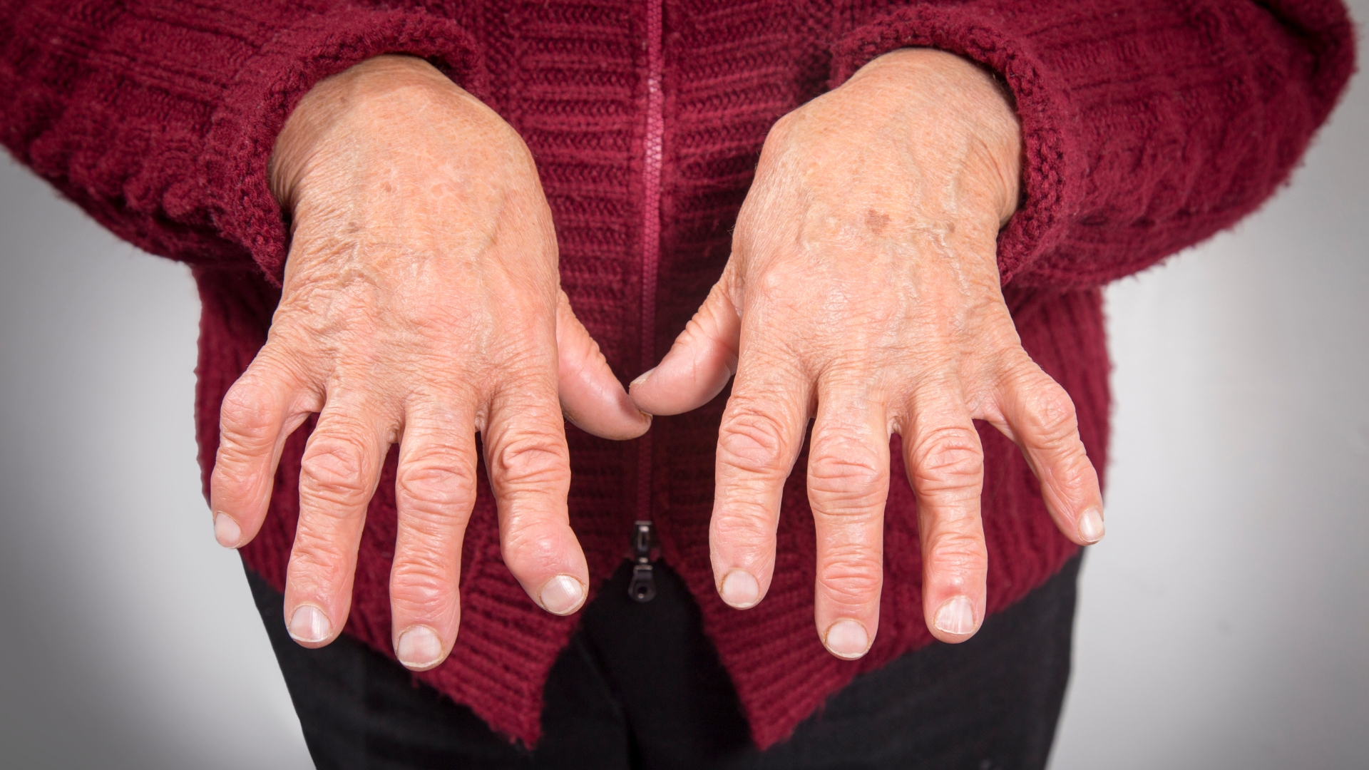 Một số bệnh lý tự miễn như lupus ban đỏ hệ thống hoặc viêm khớp dạng thấp cũng có thể gây sưng hạch