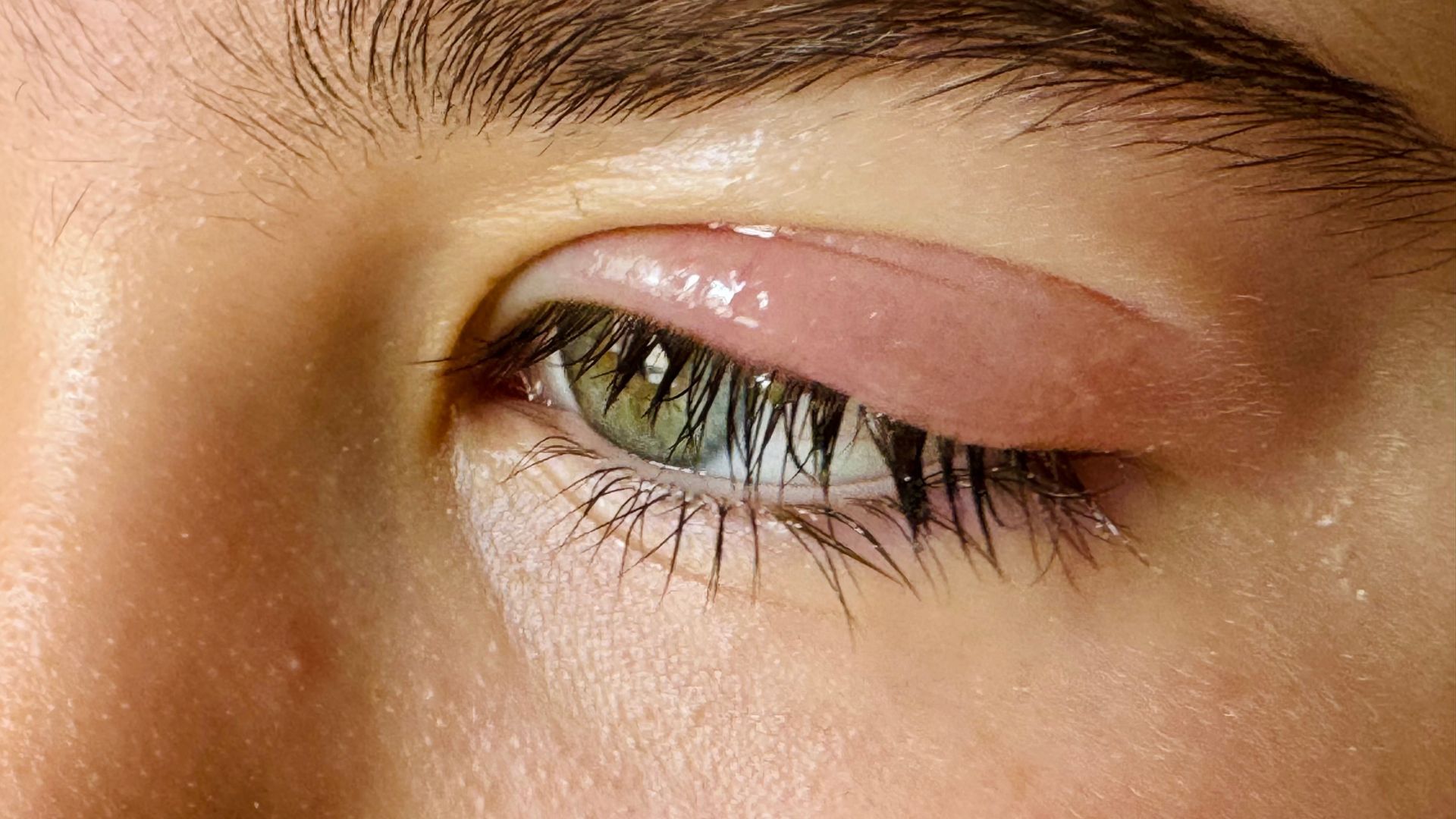 Sưng mí mắt là tình trạng thường gặp khi mí trên hoặc mí dưới bị phồng, đỏ, hoặc có cảm giác nặng và căng tức