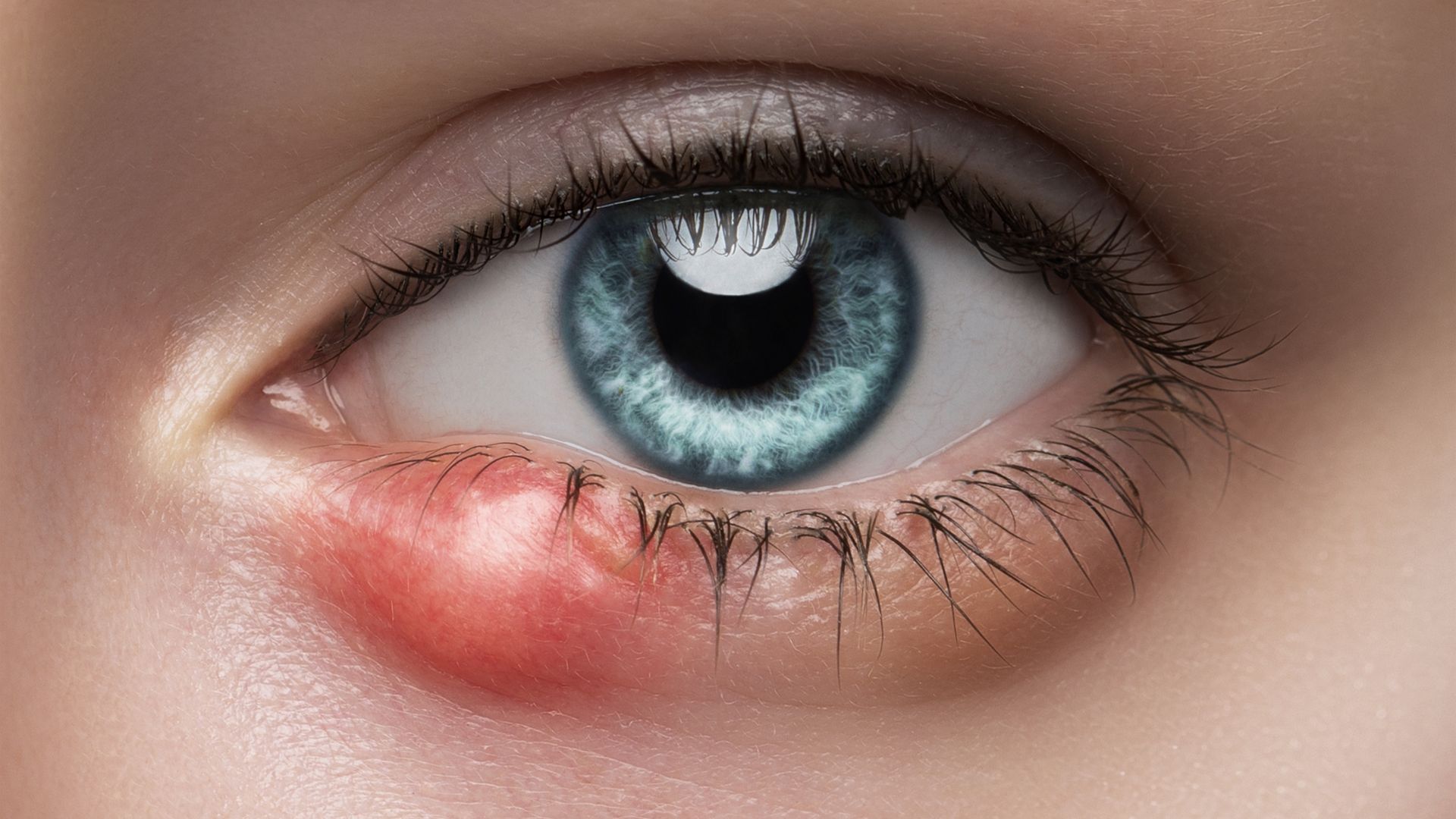 Lẹo mắt là một trong những nguyên nhân bệnh lý có thể gây sưng mí mắt