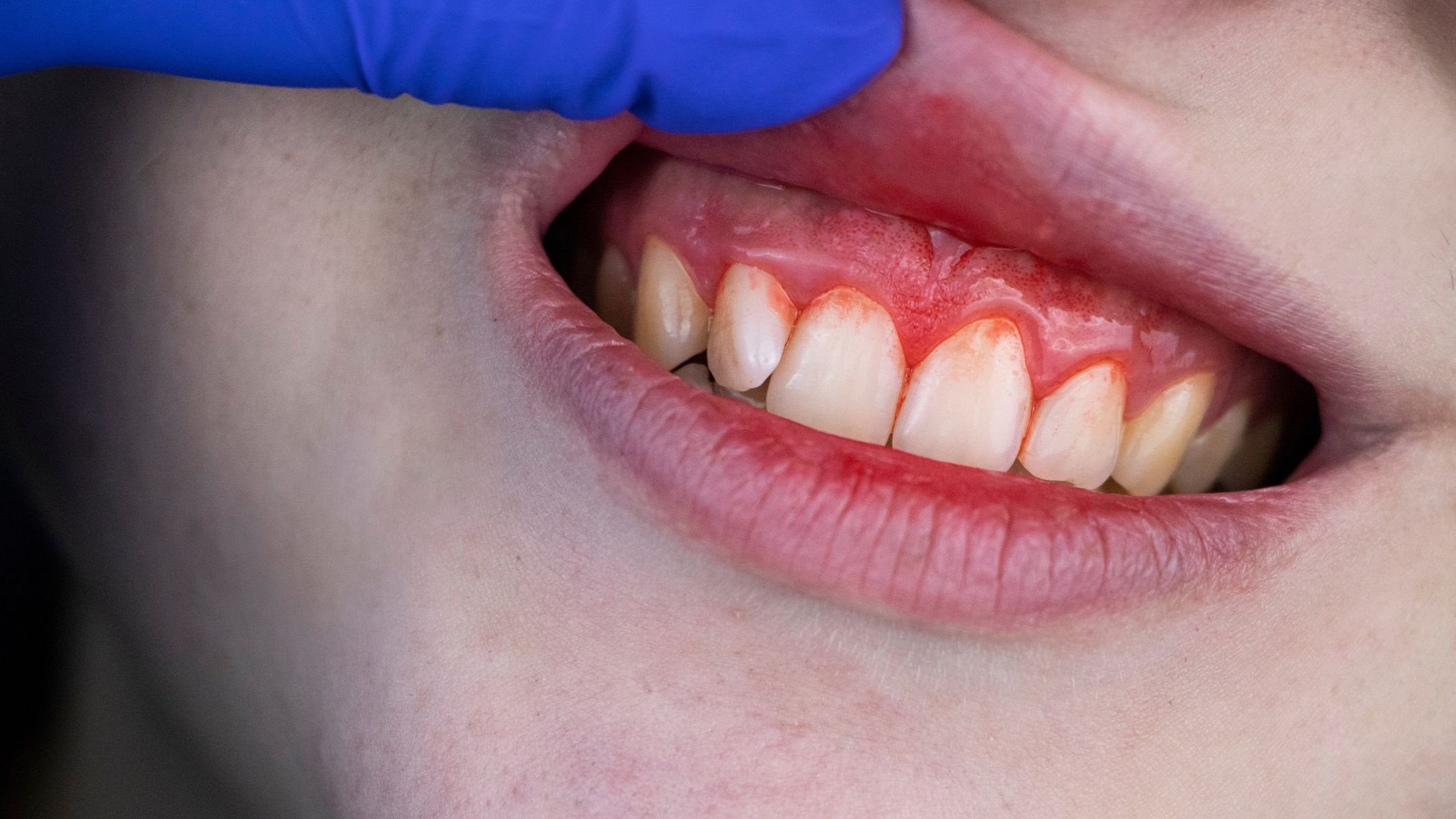 Bị sưng nướu răng có tự hết không?